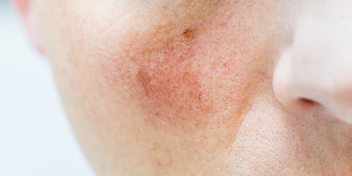 rosacea in het gezicht