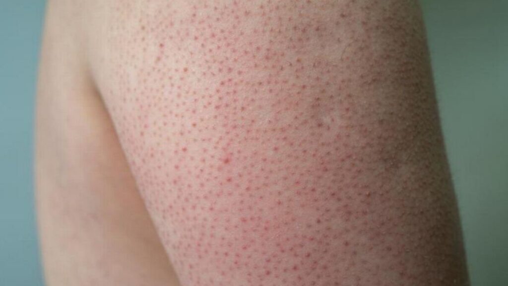 Keratosis pilaris of aardbeienhuid